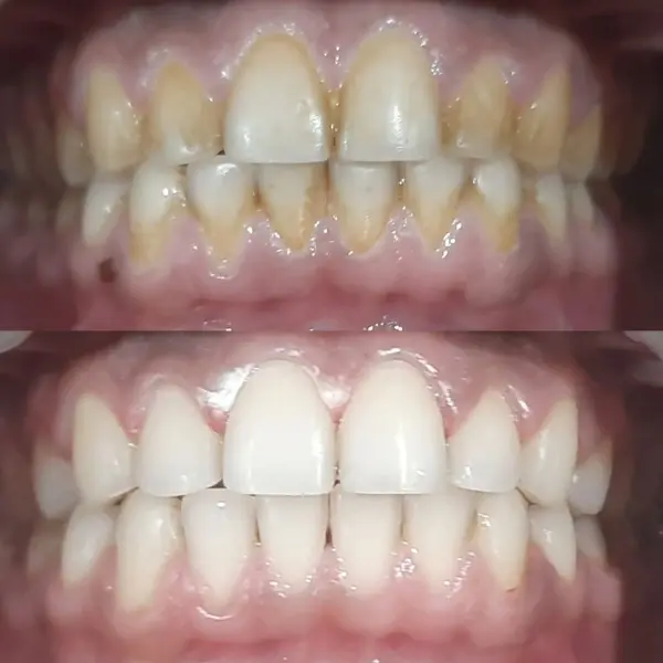 Smile Transformation
