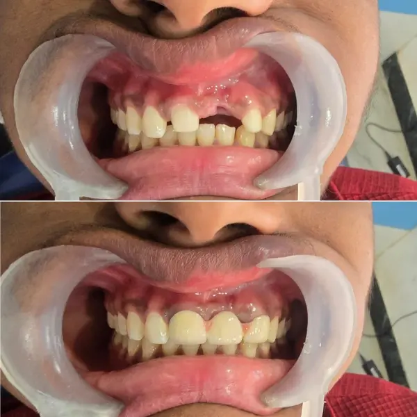 Smile Transformation