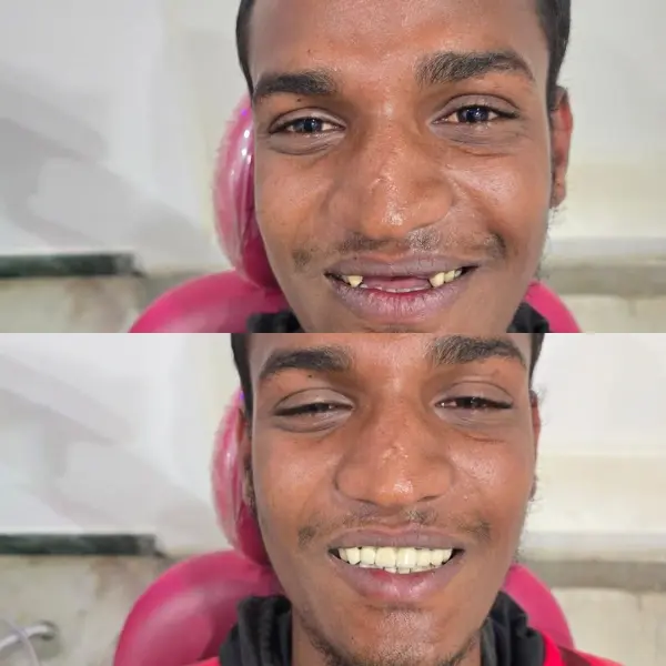 Smile Transformation