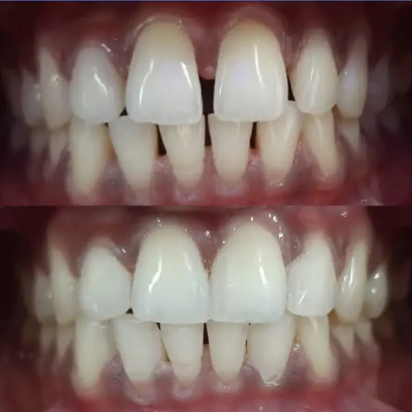 Smile Transformation