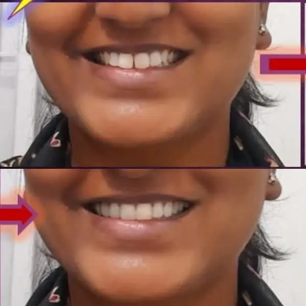 Smile Transformation