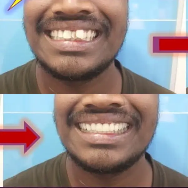 Smile Transformation