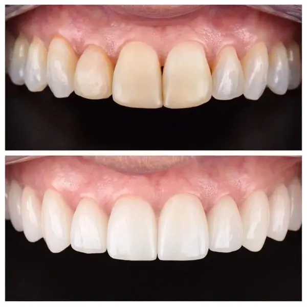 Smile Transformation