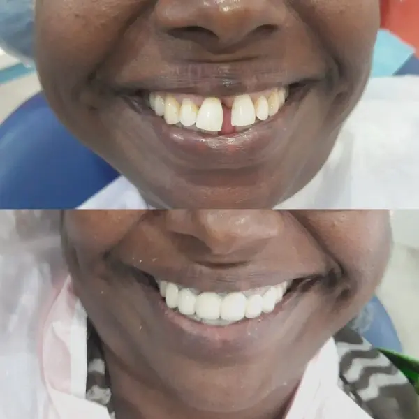 Smile Transformation
