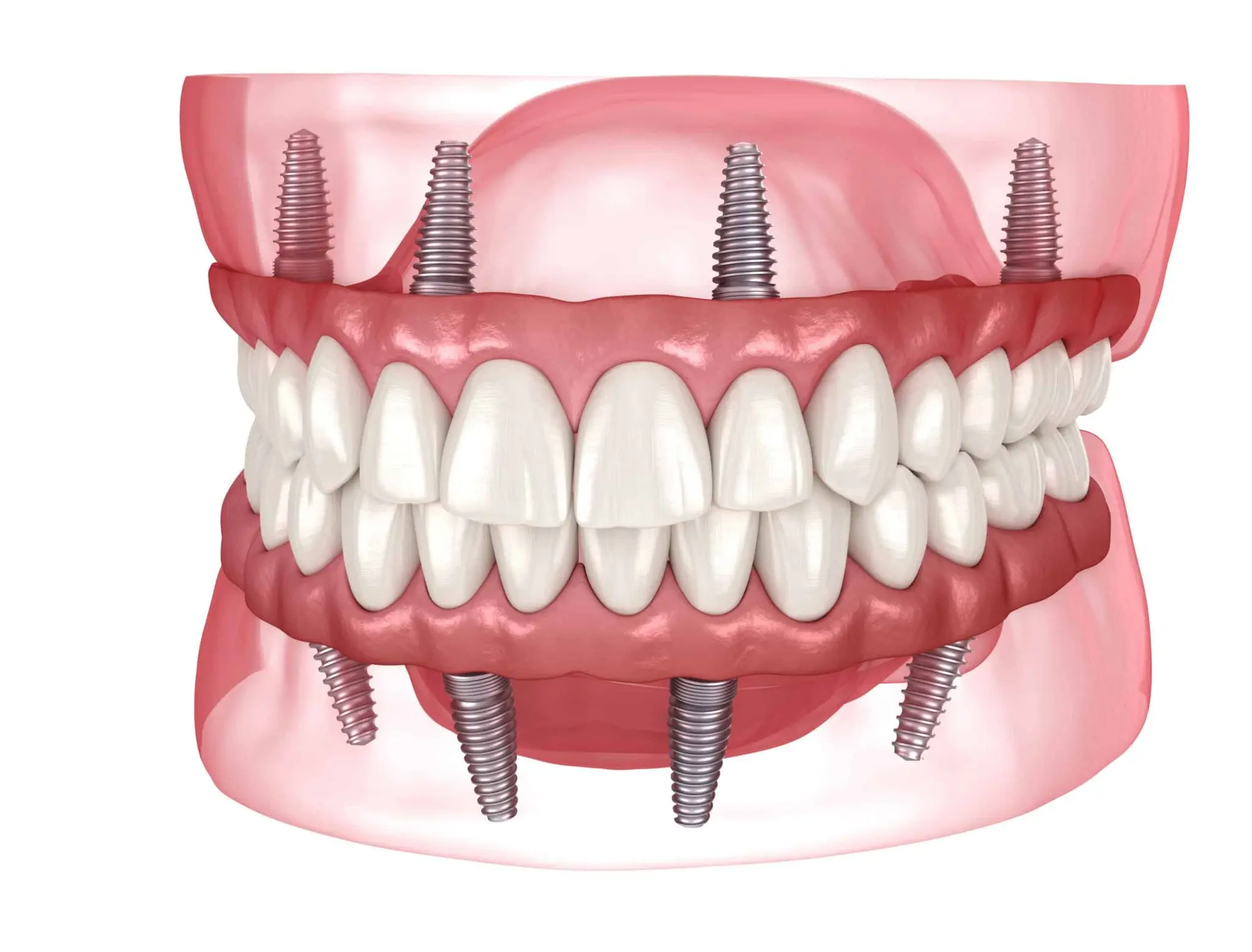 Dental Implants