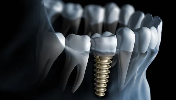 Implants & Restorations