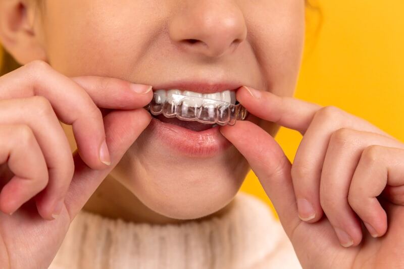 Invisalign Clear Aligners
